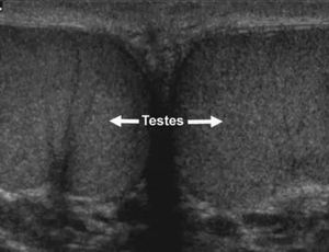 Testicular Sonography