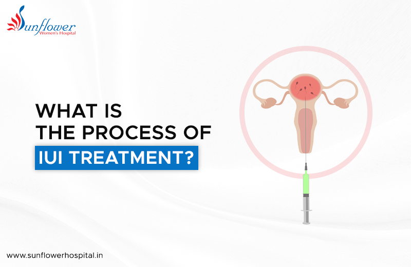 What is the Process of IUI Treatment?