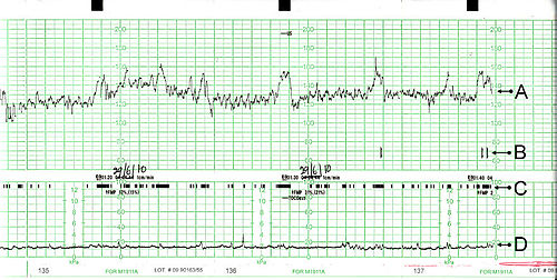 Electronic Fetal Monitoring System