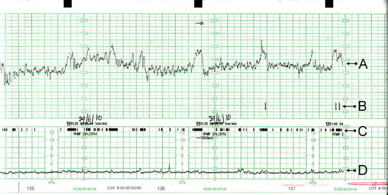 Electronic Fetal Monitoring System