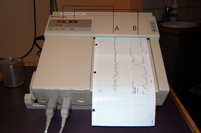 Electronic Fetal Monitoring System