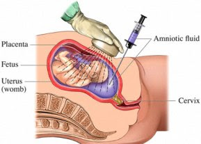 Amniocentesis