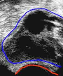 Egg retrieval ultrasound