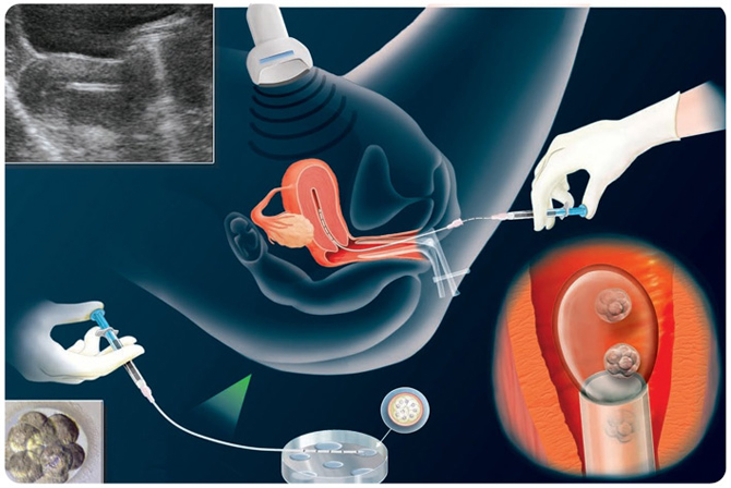 EMBRYO TRANSFER