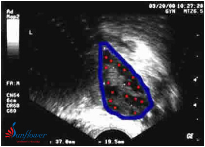  What is Antral Follicle count?