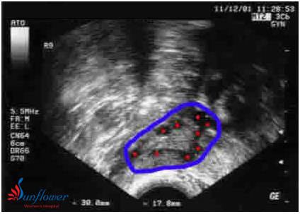  What is Antral Follicle count?