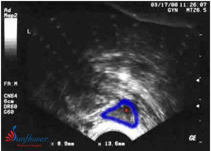  What is Antral Follicle count?