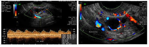 3D image of thickened endometrium