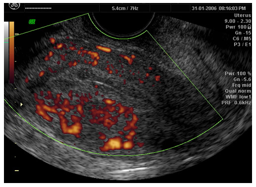  Perifollicular blood flow around