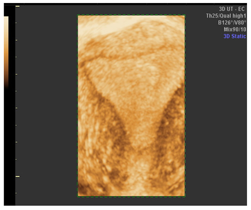 3D image of thickened endometrium