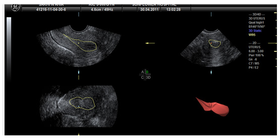  Uterine cavity volume