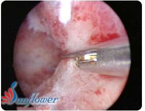 Hysteroscopy