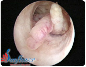 Polypectomy (Polyp)