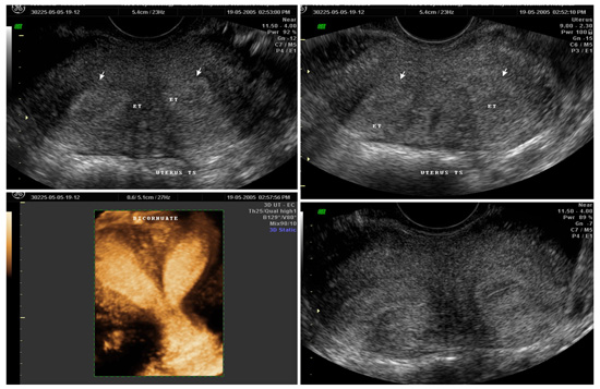 Image of an adenomyotic uterusc