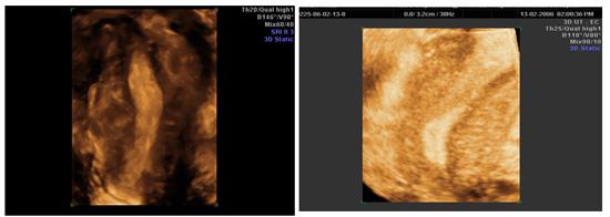  3D & 4D images of a unicornuate uterus.