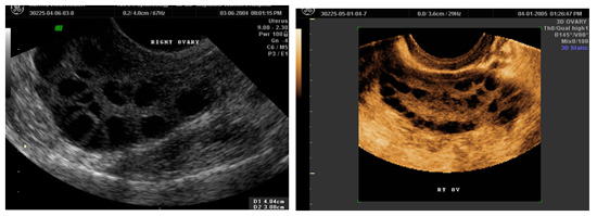  Enlarged polycystic ovaries