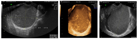  Ovarian endometriomas