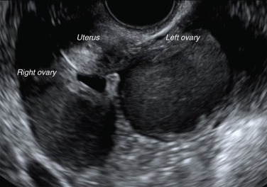 Bilateral ovarian chocolate cysts