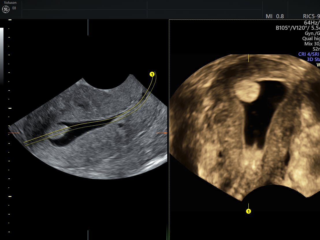 Endometrial polyp