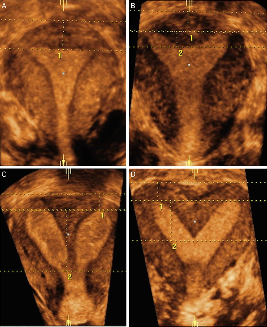 Normal, arcuate, Septate, bicornuate