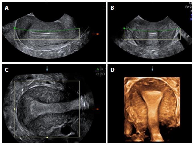 Normal uterine cavity