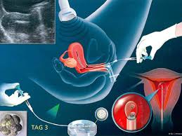 Embryo transfer