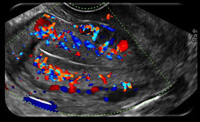 Endometrial blood flow