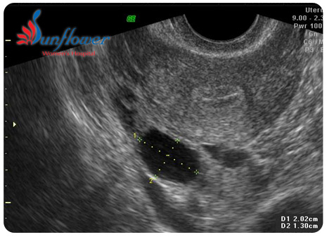 Adhrenet ovary