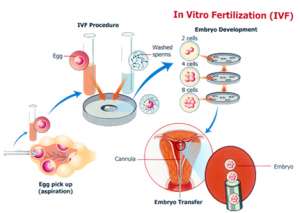 IVF