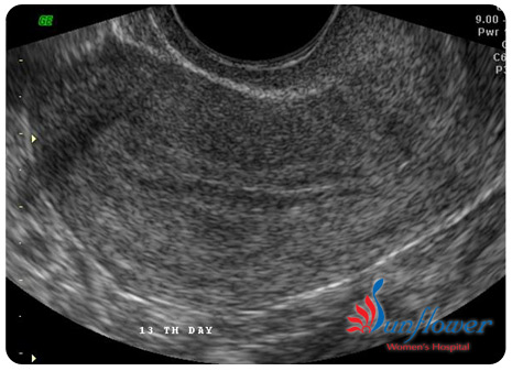 Endometrial thickness and character