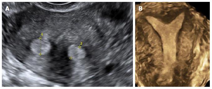 Sub septate uterine cavity