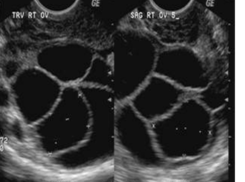 Ovulation Induction 2