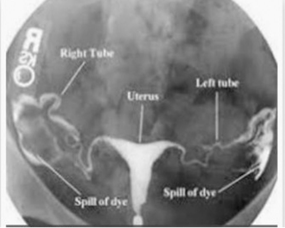 Tubal Patency Test