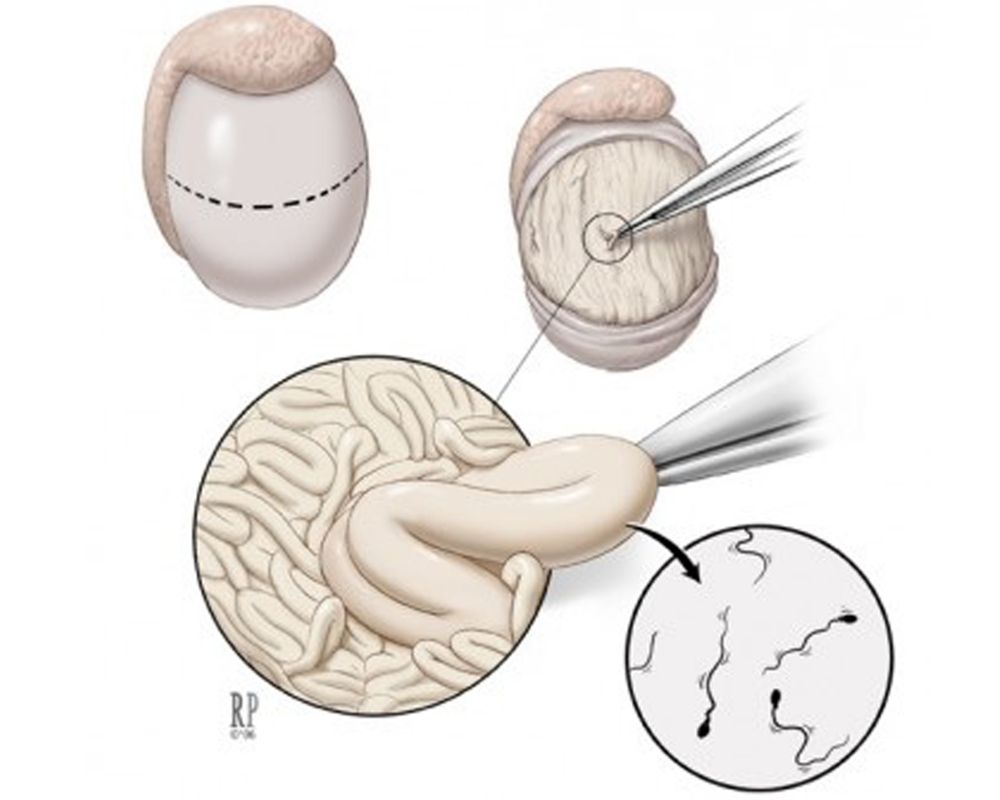 Surgical Sperm Retrieval 3