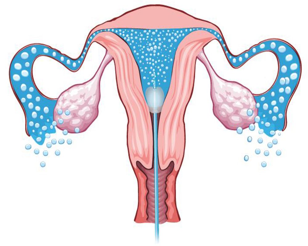 Sonosalpingogram