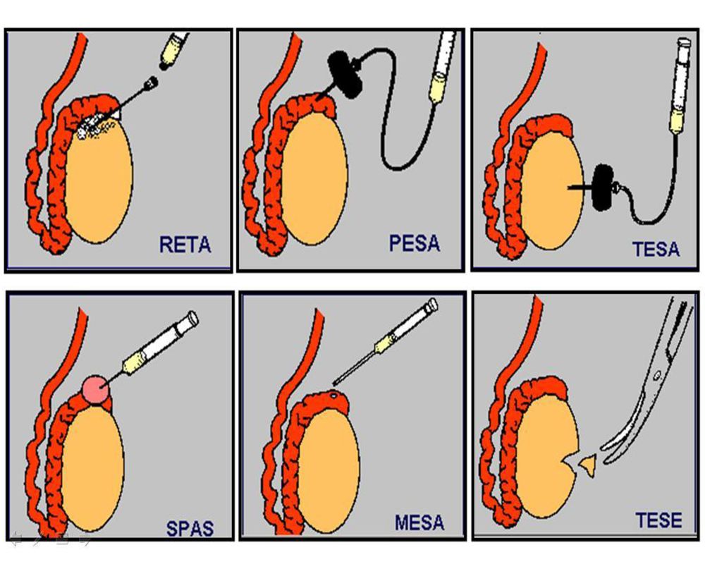 Surgical Sperm Retrieval 4