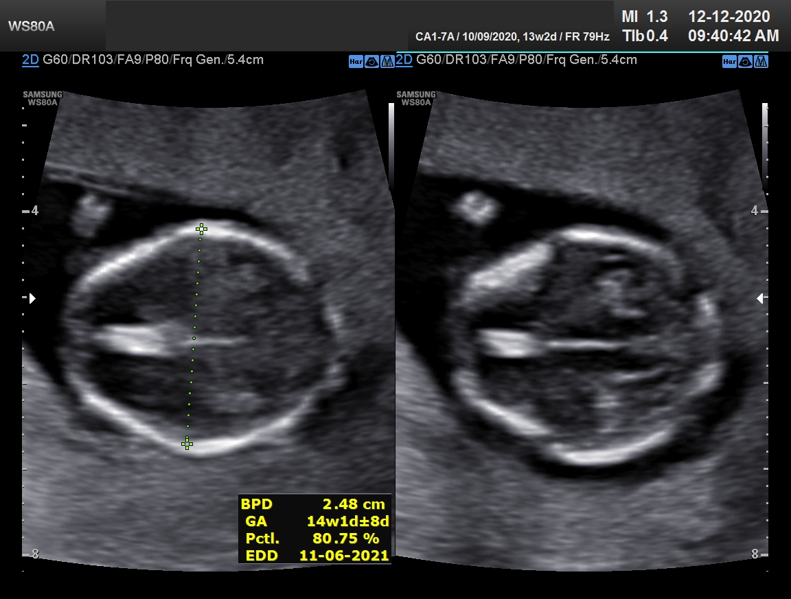 Sonography Image