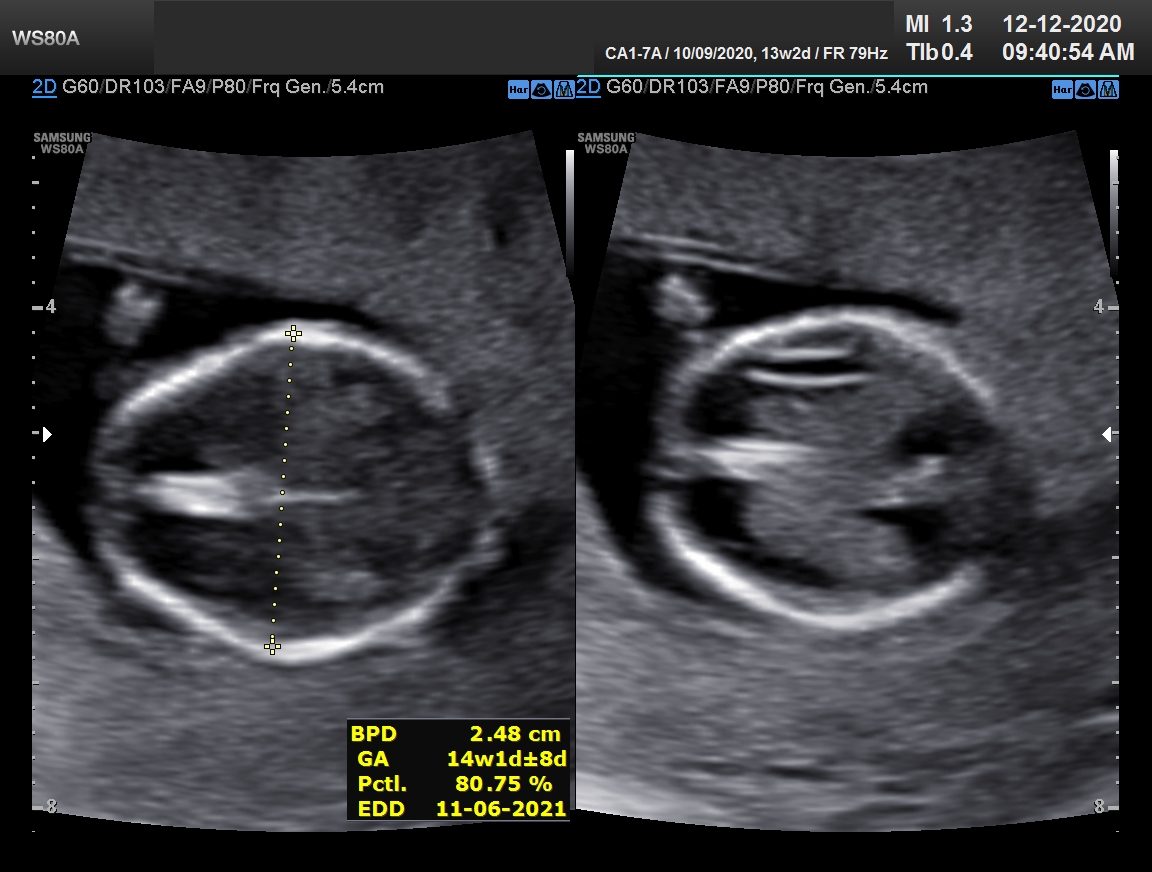 Sonography Image