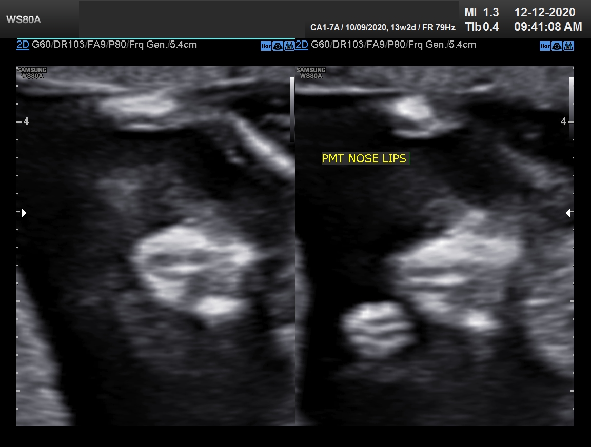 Sonography Image