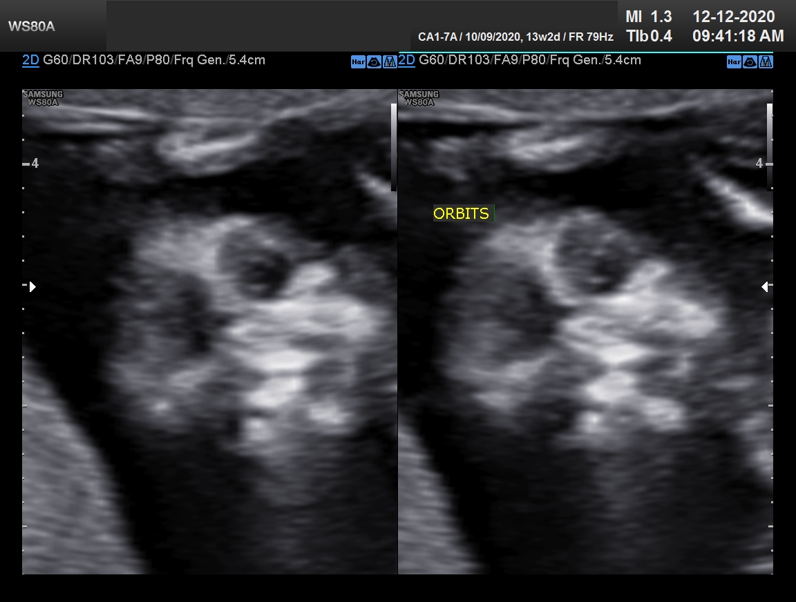 Sonography Image