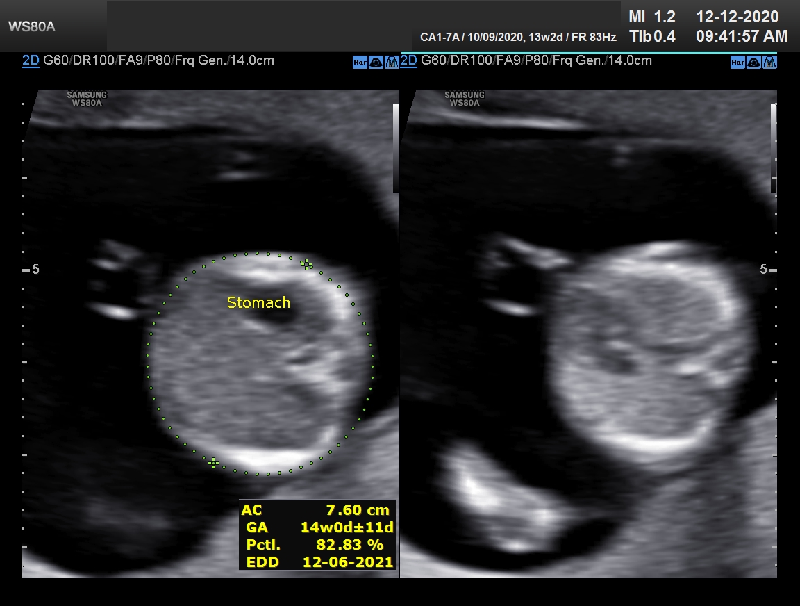 Sonography Image