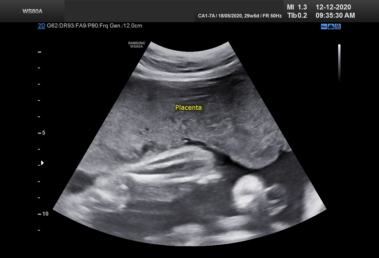 Sonography Image