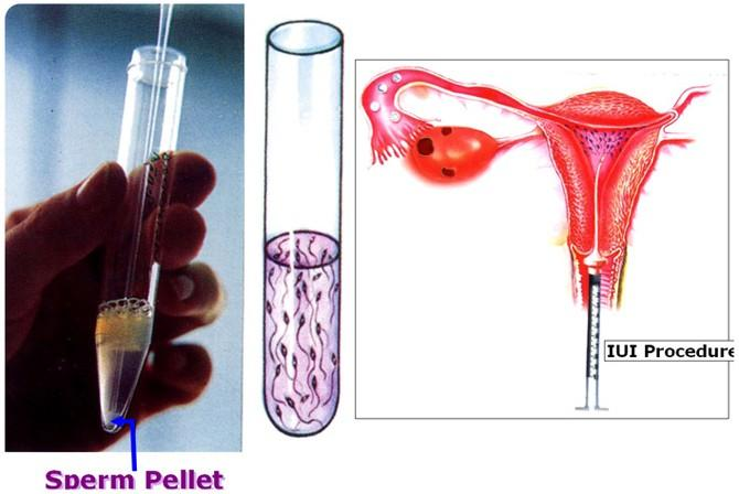 Sperm Washing Technique