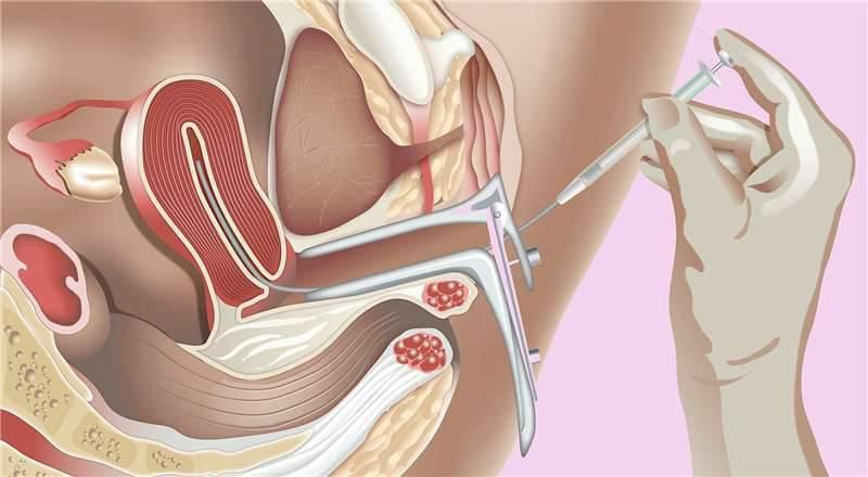 Insemination