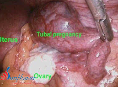 Ectopic Pregnancy