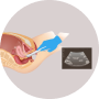 Mid cycle uterine examination by transvaginal sonography