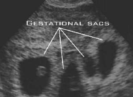 Multiple pregnancy