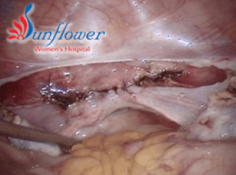 T.L.H.(Total Laproscopic Hysterectomy)