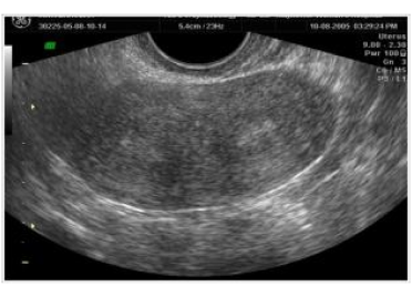 Septate uterus