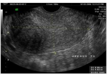 USG image of Polycystic Ovary